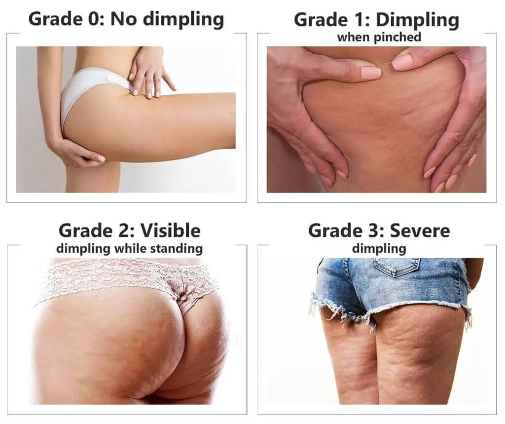 Representation of the stages of cellulite development Royal Wootton Bassett